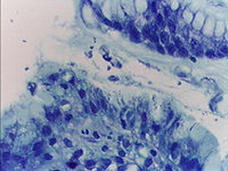 диагностика инфекции helicobacter pylori