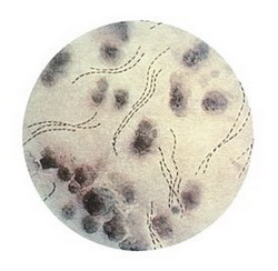 haemophilus ducreyi